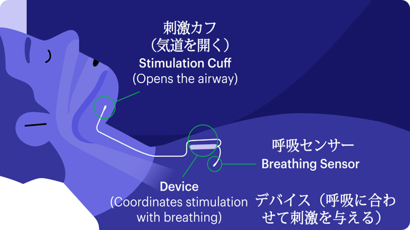 胸部の装置から舌下神経へ刺激を送るInspireの植込み位置と仕組みの模式図
