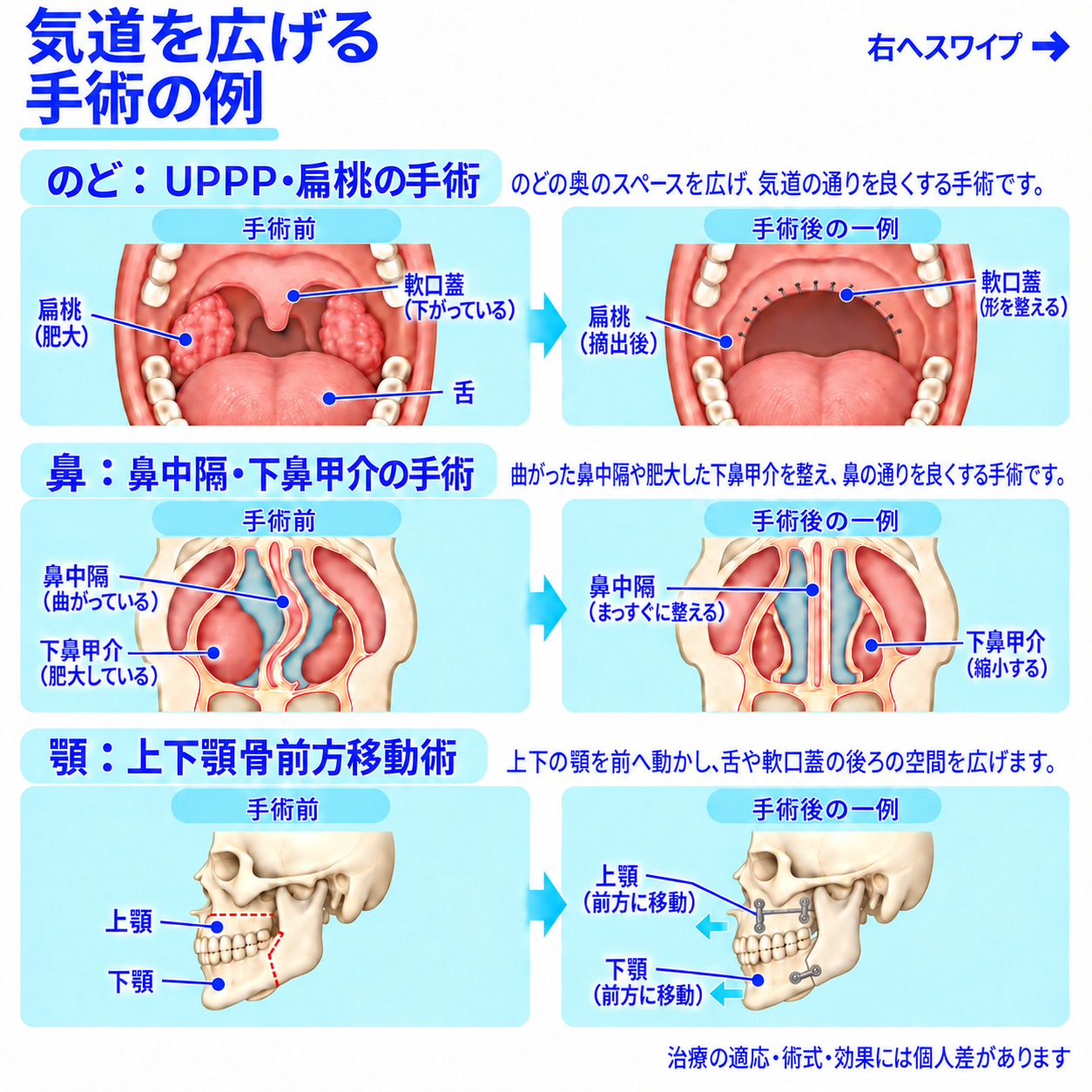 のど・鼻・顎の手術前と手術後の一例を比較した図